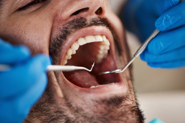 Best Emergency Dentist for Lost Fillings or Crowns in Mattituck, NY