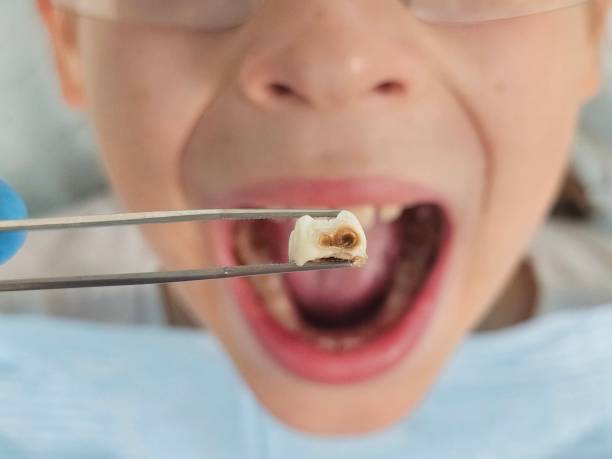 Best Emergency Dentist for Lost Fillings or Crowns in Mattituck, NY
